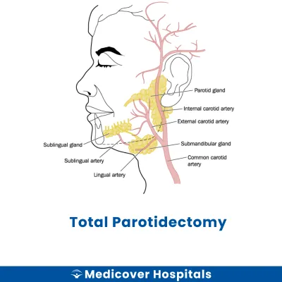 Total Parotidectomy