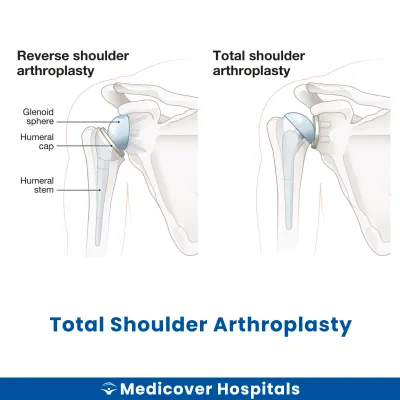 Total Shoulder Arthroplasty