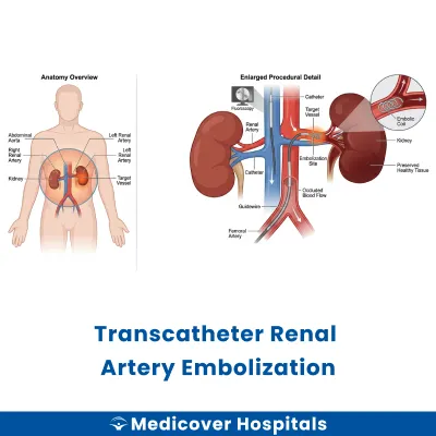 Transcatheter Renal Artery Embolization
