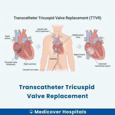 Transcatheter Tricuspid Valve Replacement