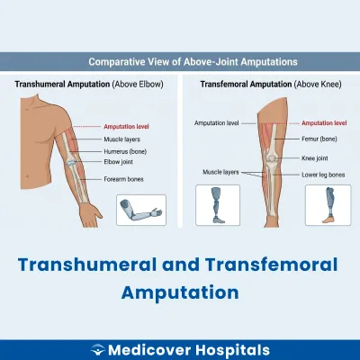 Transhumeral and Transfemoral Amputation