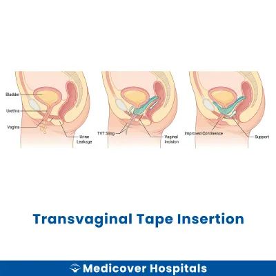 Transvaginal Tape Insertion