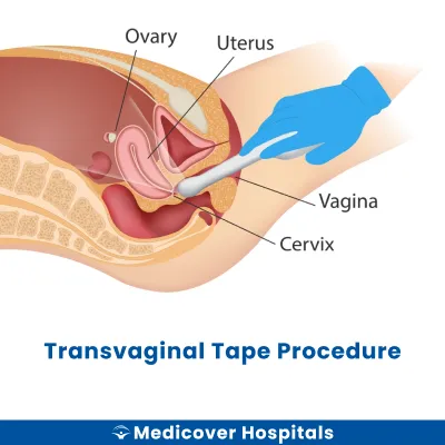 Transvaginal Tape Procedure