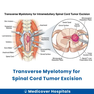 Transverse Myelotomy for Spinal Cord Tumor Excision