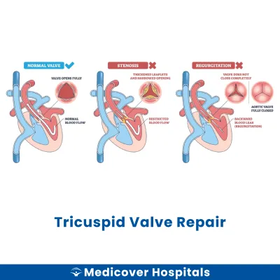 Tricuspid Valve Repair