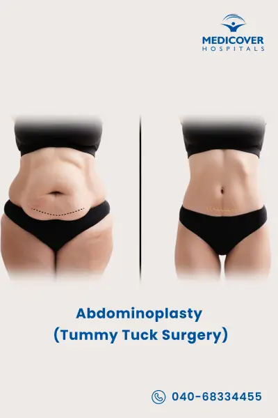 tummy-tuck-surgery