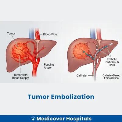 Tumor Embolization