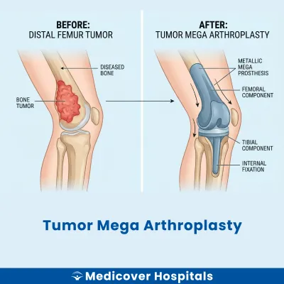 Tumor Mega Arthroplasty