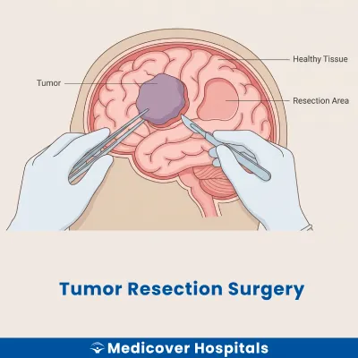 Tumor Resection Surgery