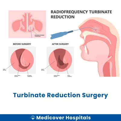 Turbinate Reduction Surgery
