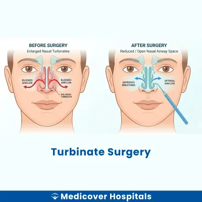 Turbinate Surgery