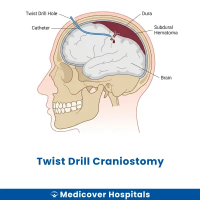 Twist Drill Craniostomy