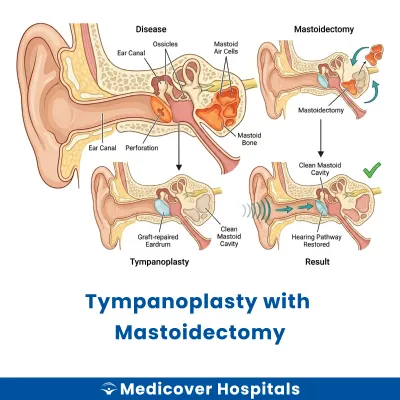 Tympanoplasty With Mastoidectomy