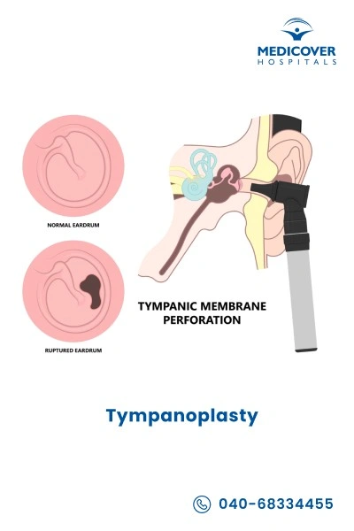 tympanoplasty