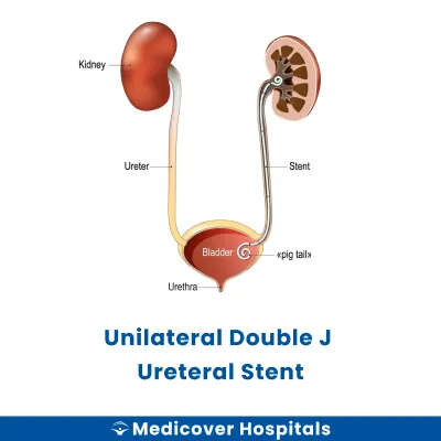 Unilateral Double J Ureteral Stent