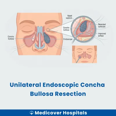 Unilateral Endoscopic Concha Bullosa Resection
