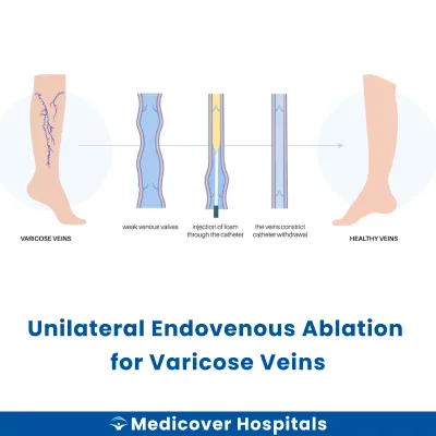 Unilateral Endovenous Ablation for Varicose Veins