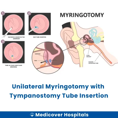 Unilateral Myringotomy With Tympanostomy Tube Insertion