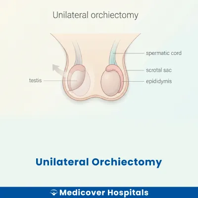 Unilateral Orchiectomy