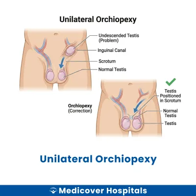Unilateral Orchiopexy