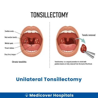 Unilateral Tonsillectomy