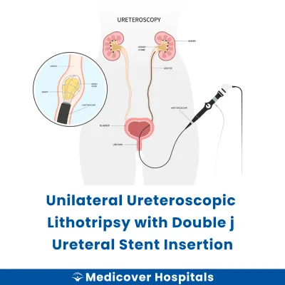 Unilateral Ureteroscopic Lithotripsy With Double J Ureteral Stent Insertion