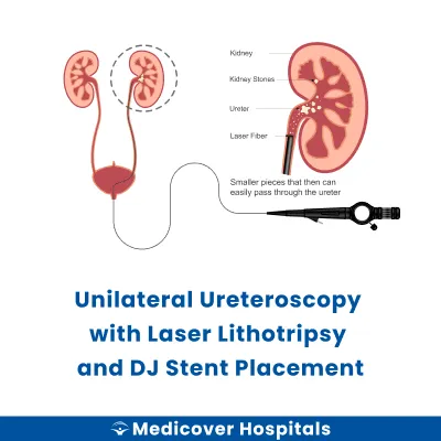 Unilateral Ureteroscopy With Laser Lithotripsy and Dj Stent Placement