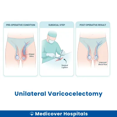 Unilateral Varicocelectomy