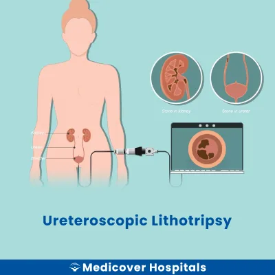 Ureteroscopic Lithotripsy