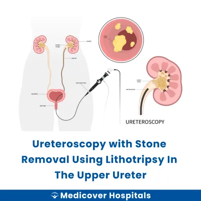 Ureteroscopy With Stone Removal Using Lithotripsy In The Upper Ureter
