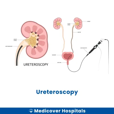 Ureteroscopy