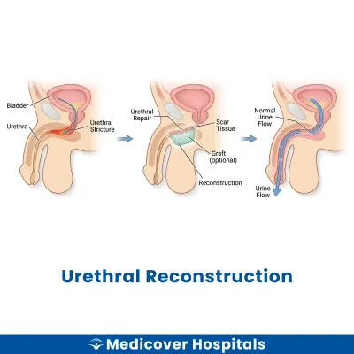 Urethral Reconstruction