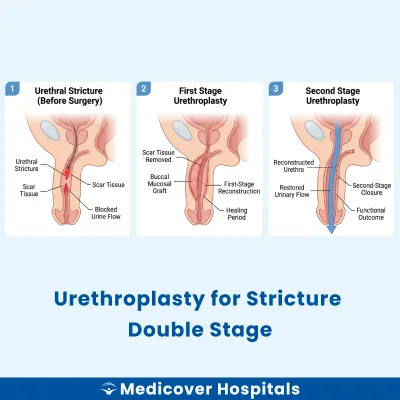 Urethroplasty for Stricture Double Stage