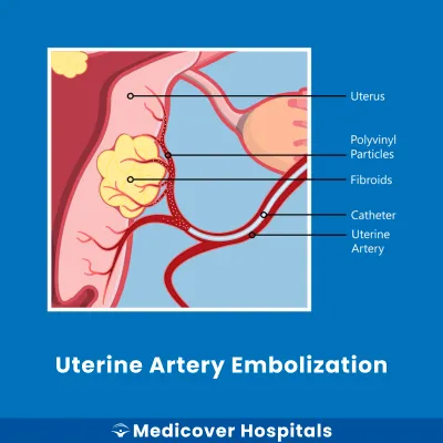 Uterine Artery Embolization