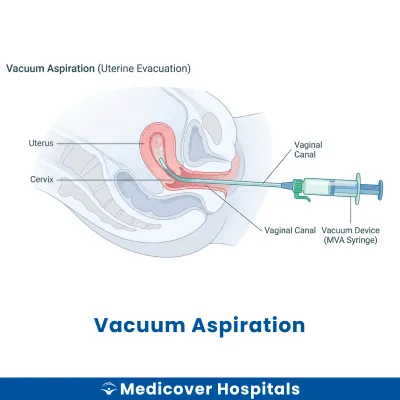 Vacuum Aspiration