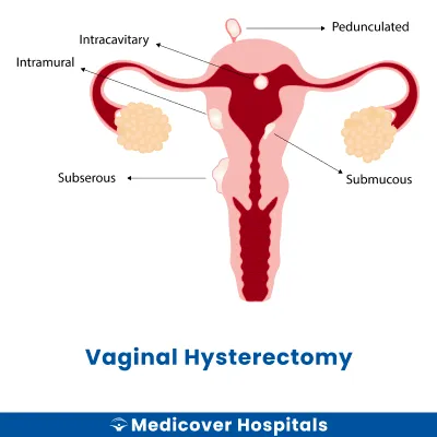 Vaginal Hysterectomy