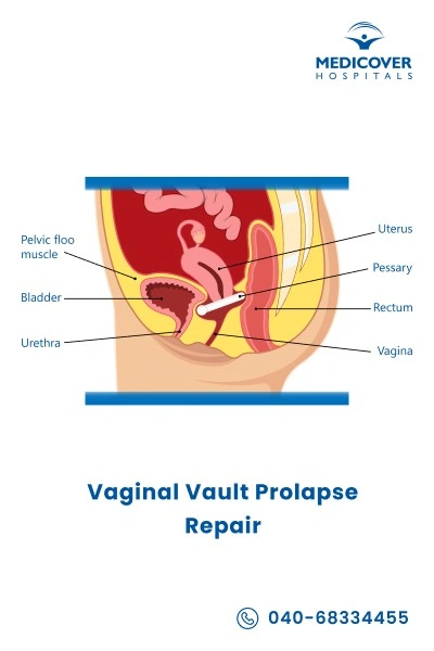 vaginal-vault-prolapse-repair