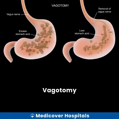 Vagotomy