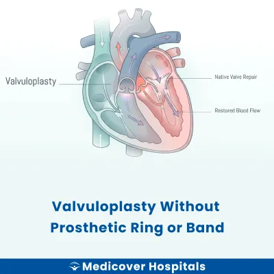 Valvuloplasty Without Prosthetic Ring Or Band