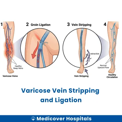 Varicose Vein Stripping and Ligation