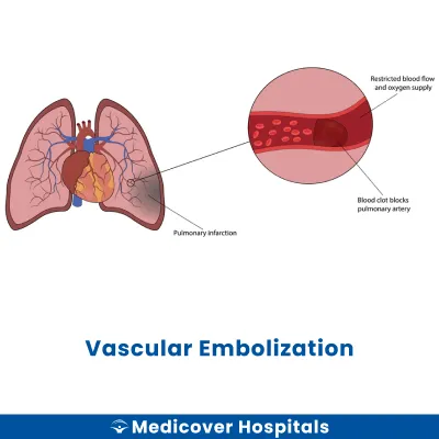 Vascular Embolization