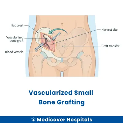 Vascularized Small Bone Grafting