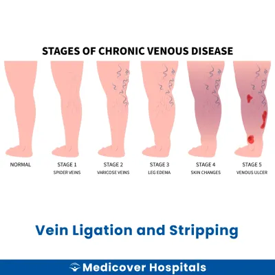 Vein Ligation and Stripping