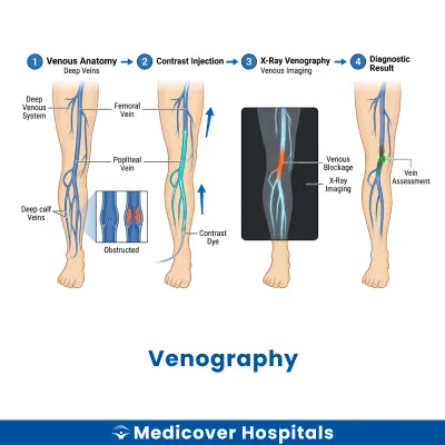 Venography