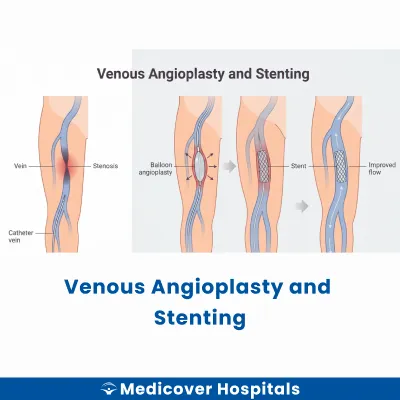 Venous Angioplasty and Stenting