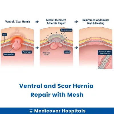 Ventral and Scar Hernia Repair With Mesh