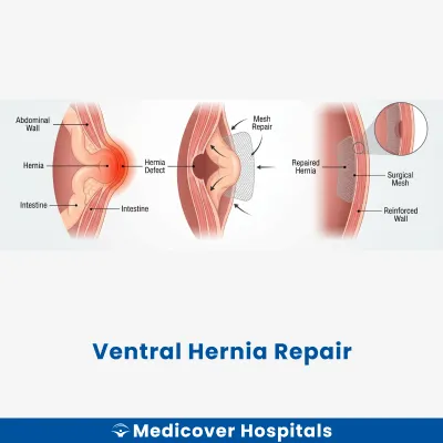 Ventral Hernia Repair