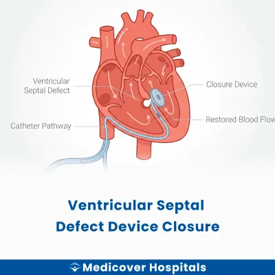 Ventricular Septal Defect Device Closure
