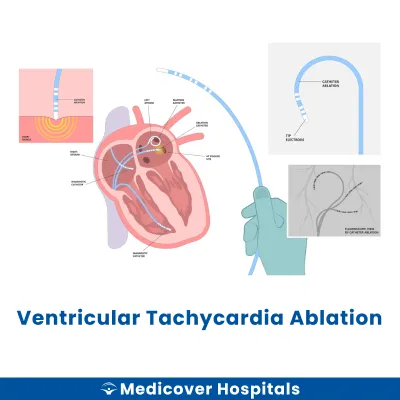 Ventricular Tachycardia Ablation