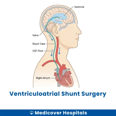 Ventriculoatrial Shunt Surgery